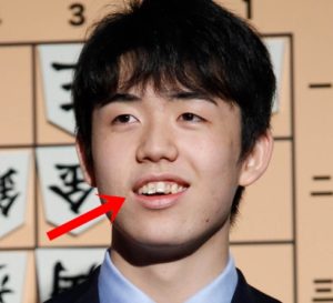 藤井聡太の歯並びが悪い 汚い 歯列矯正を止めたのは将棋が出来なくなるから 画像 カツタのつぶやき